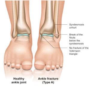 There are different types of foot fractures, learn how to identify each