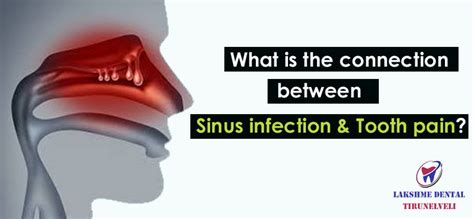 Sinus Infection Tooth Pain Sinus Toothache