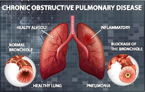 Chronic Obstructive Pulmonary Disease Diagram Sciences Pathology Vector