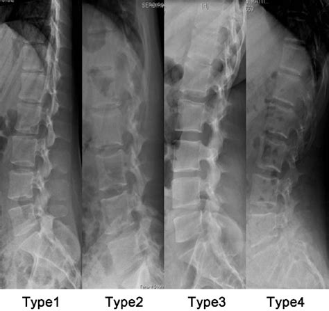 Sagittal Spinal Alignment Type On Standing X Ray Standing X Rays