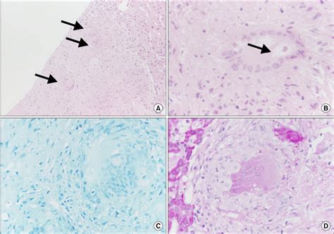 Liver Biopsy Showing The Non Caseating Granuloma Arrows A And Download Scientific Diagram