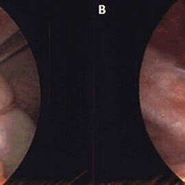 Intraoperative Visualization Of The Appendix A Intussusception Of