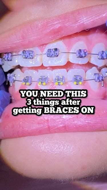 Top Two Tips To Prevent White Spots On Teeth When You Get Braces Off Braces Braceson Bracesoff