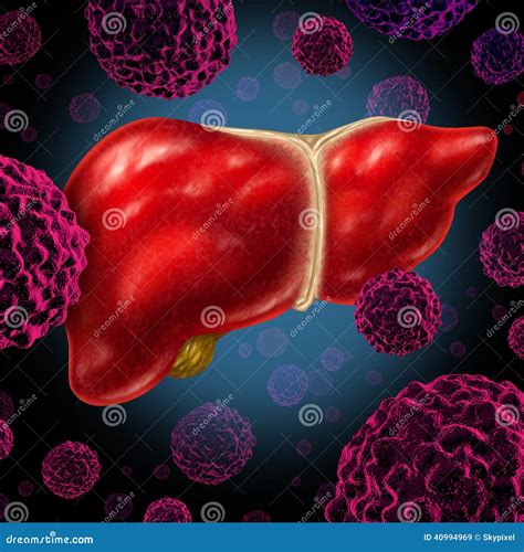 Liver Cancer Diagram