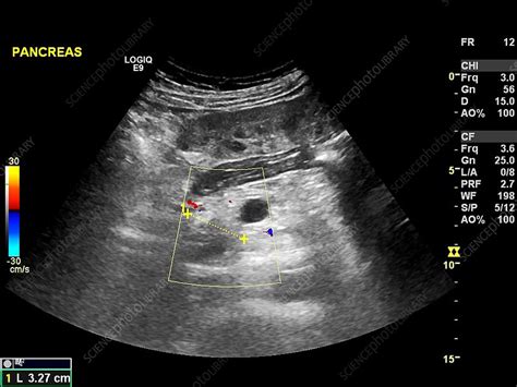 Secondary pancreatic cancer, ultrasound - Stock Image - C017/7765 - Science Photo Library