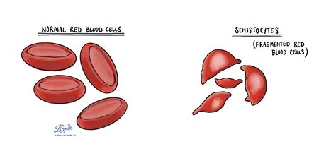 Schistocytes | MyPathologyReport.ca