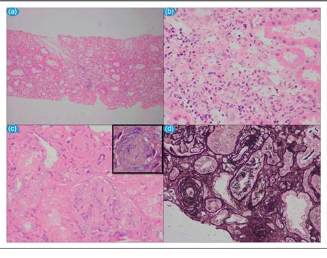 Pediatric Onset Lupus Nephritis In Western Indiais It Different From