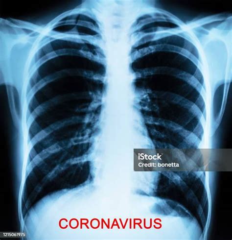 Gambar Radiografi Atau Gambar Xray Dada Manusia Foto Stok Unduh