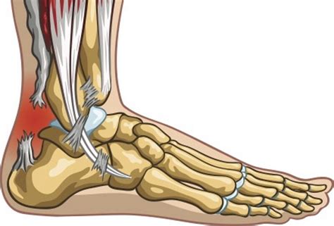 Achilles Tendon Rupture Surgery Or Non Surgical Treatment