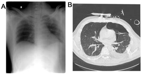 Flail Chest | Concise Medical Knowledge