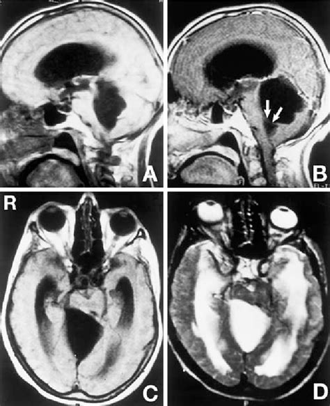 Figure 1 From Unusual Arachnoid Cyst Of The Quadrigeminal Cistern In An