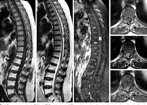 Figure 1 from Myelopathy due to Thoracic Intradural Extramedullary Tumor Misdiagnosed as the ...