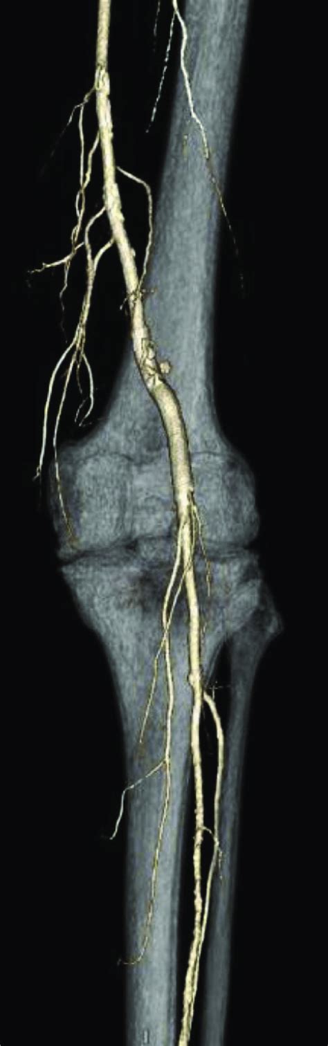 Postoperative Computed Tomography Ct Angiography Reconstructed Image Download Scientific