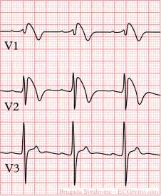 Brugada Syndrome