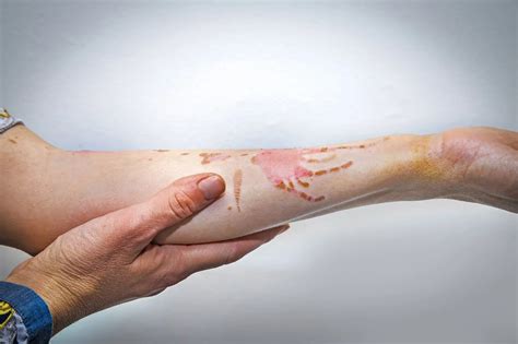 Infected Burns When To Seek Treatment Coastal