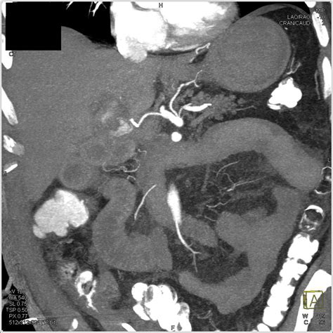 Gastroduodenal Artery GDA Pseudoaneurysm Following Whipple Procedure