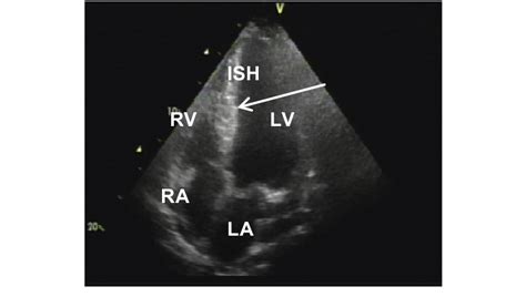 Two Dimensional Echocardiogram Left Ventricular Longitudinal Long Axis