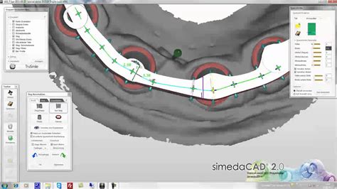 SimedaCAD ExoCAD The Basic Bar Module Functions YouTube