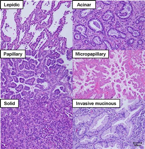 The New Iaslc Ats Ers Lung Adenocarcinoma Classification What The