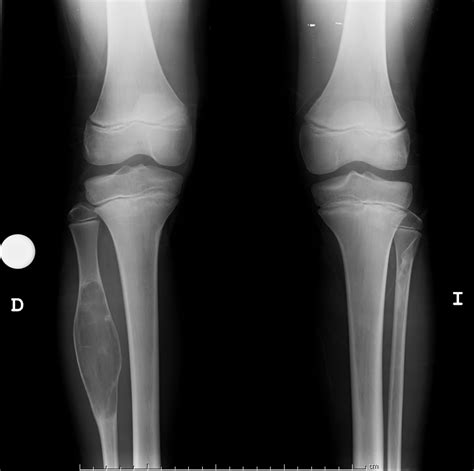 Fibroma Osificante Tibia