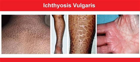 Ichthyosis Vulgaris Face