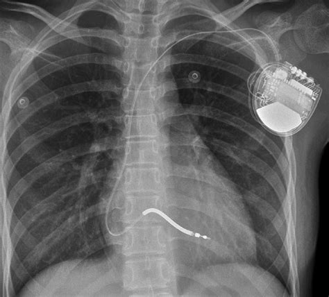 Chest X Ray After The Implantation Of The Implantable Download