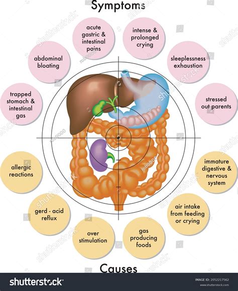 Medical Illustration Symptoms Causes Colic Stock Vector (Royalty Free ...