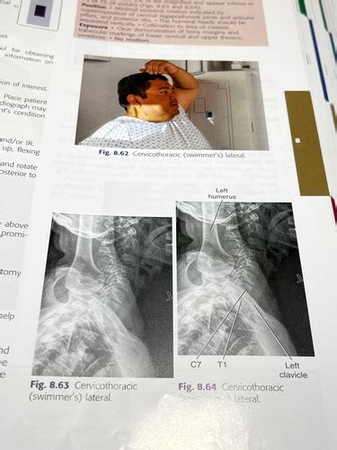 Chapter 8 Cervical And Thoracic Spine Projections Flashcards Quizlet