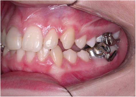 Effects Of The Forsus Fatigue Resistant Device And Mandibular Anterior Repositioning Appliance