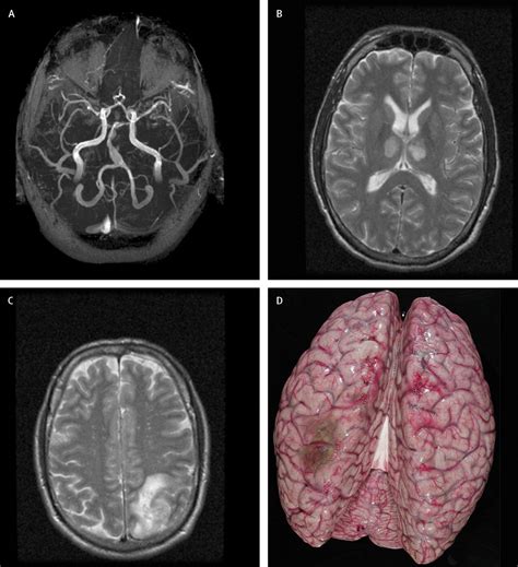 Pneumococcal Meningitis In Adults New Approaches To Management And