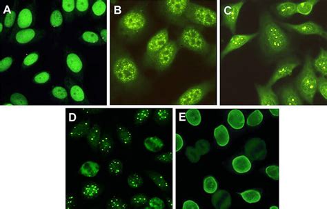 Anti Nuclear Antibodies Ana Detected On Hep2 Cells By Indirect