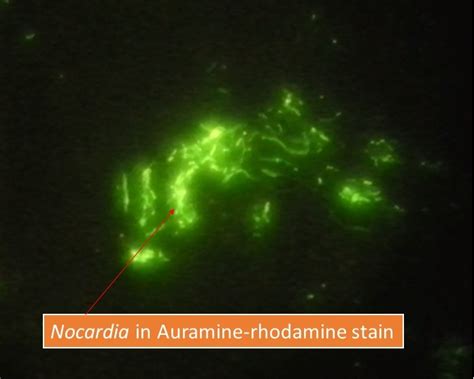 Nocardia In Auramine Rhodamine Stain Introduction Principle Procedure