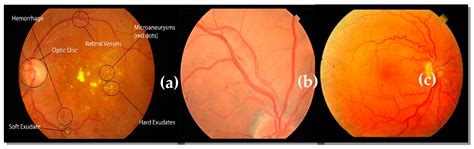 Computer Aided Detection Of Hypertensive Retinopathy Using Depth Wise