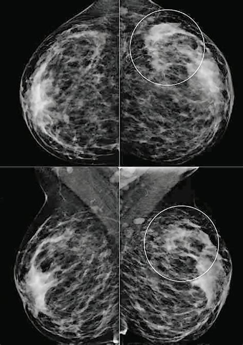 Scielo Brasil Imaging Features Of Idiopathic Granulomatous Mastitis