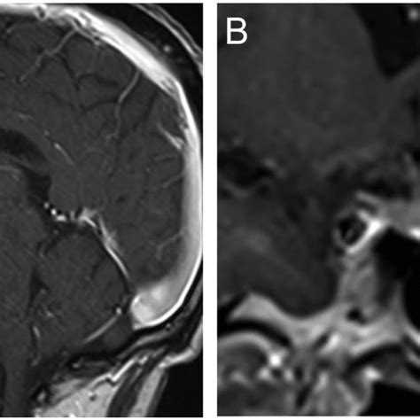 Gadolinium Enhanced T1 Weighted Pituitary Mri Images With Sagittal A