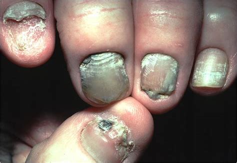 Green Nail Syndrome