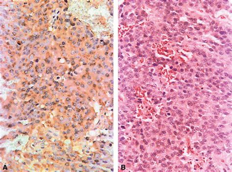 Treatments Of Multi Invasive Giant Prolactinoma Journal Of Clinical