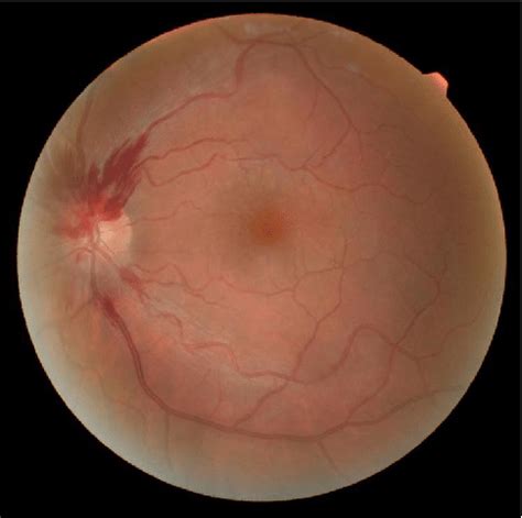 Left eye fundoscopy reveals small vitreous hemorrhage above the optic... | Download Scientific ...