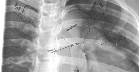 RAO Sternum From KU Radiographic Anatomy Radiographic Anatomy