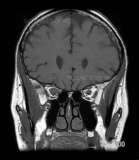 Photograph | MRI Optic Nerve Glioma in Adult | Science Source Images