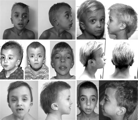 Noonan Syndrome Adults