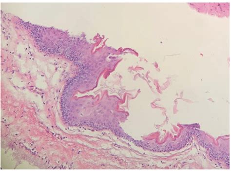 Histopathology Determined An Epidermal Cyst Lined By Stratified