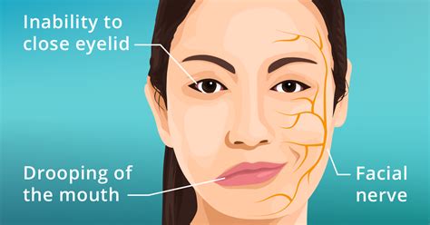 Bell S Palsy And Its Physiotherapy Intervention