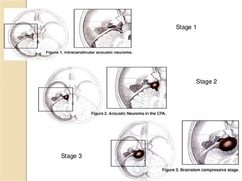 Acoustic Neuroma