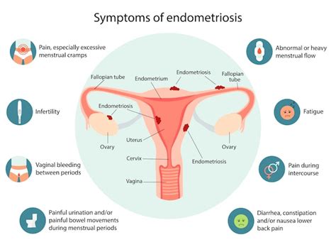 Infografía de los síntomas de la endometriosis infografía vectorial