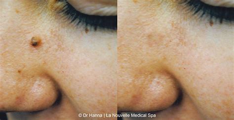 Mole Removal Before And After Photos By Dr Hanna Ventura