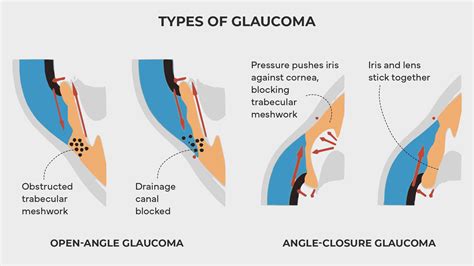 Understanding Glaucoma Symptoms Causes Treatments Atlus