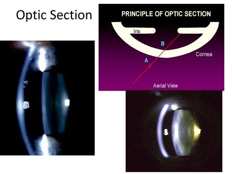 Slit lamp techniques.pptx