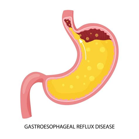 Gastroesophageal Reflux Disease And Heartburn Illustration 18990076