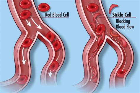 Fda Approves Groundbreaking Cell Based Gene Therapies For Sickle Cell